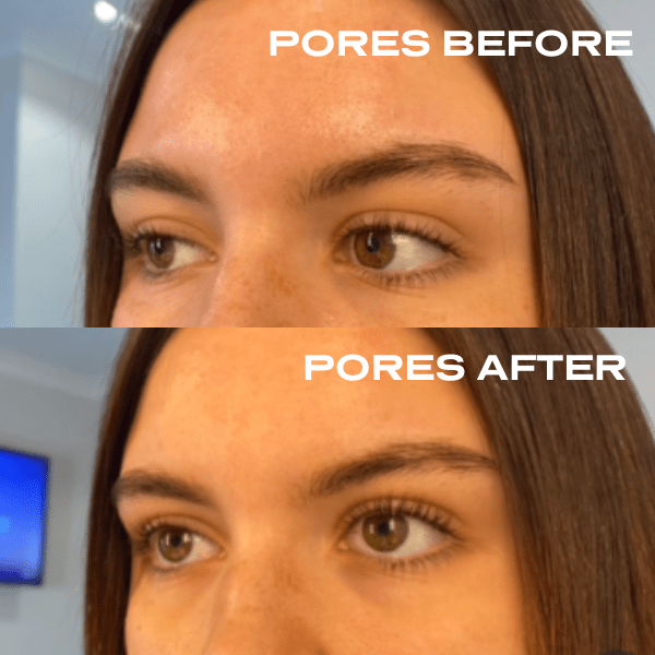 No Needles Dermal Filler - Starter Kit