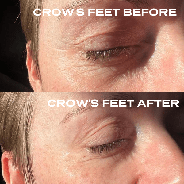 No Needles Dermal Filler - Starter Kit