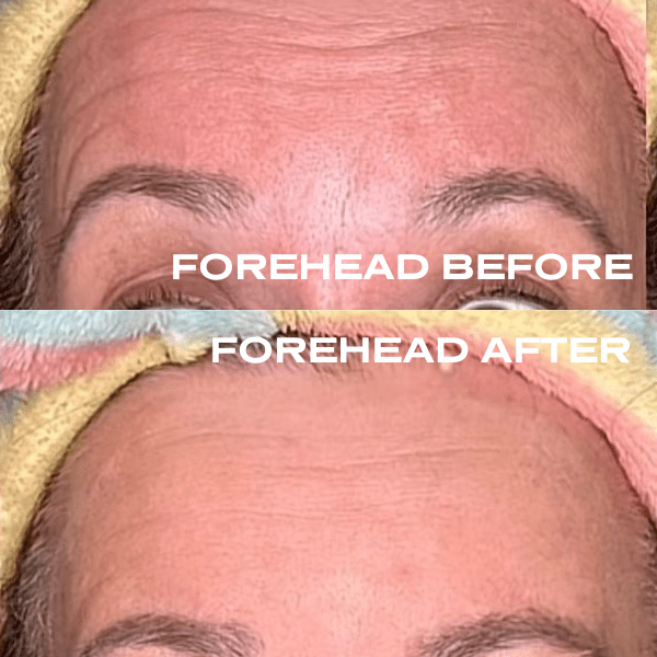 No Needles Dermal Filler