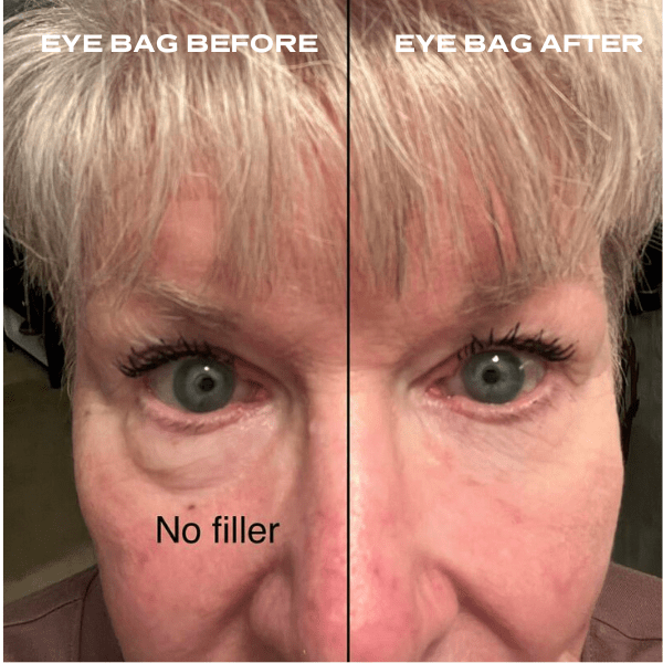 No Needles Dermal Filler