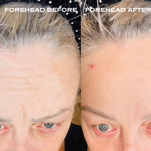 No Needles Dermal Filler - Starter Kit