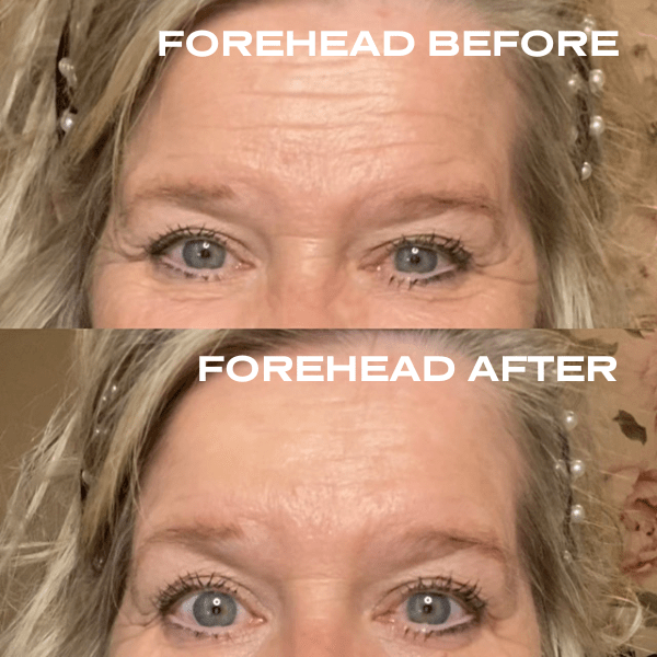 No Needles Dermal Filler - Starter Kit