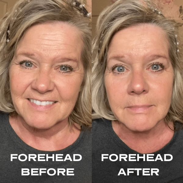 No Needles Dermal Filler - Starter Kit