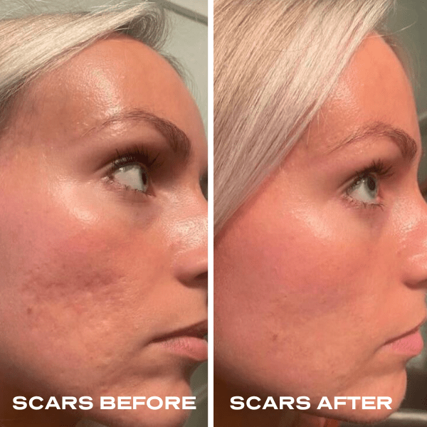 No Needles Dermal Filler