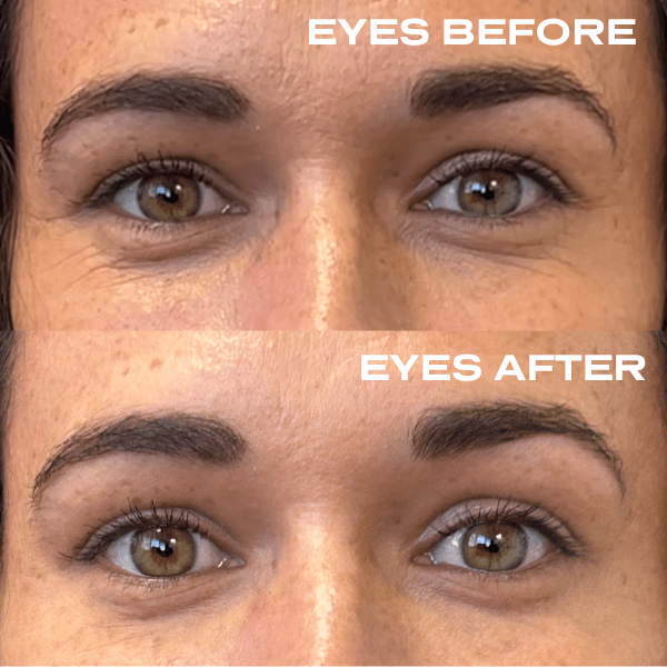 No Needles Dermal Filler - Starter Kit
