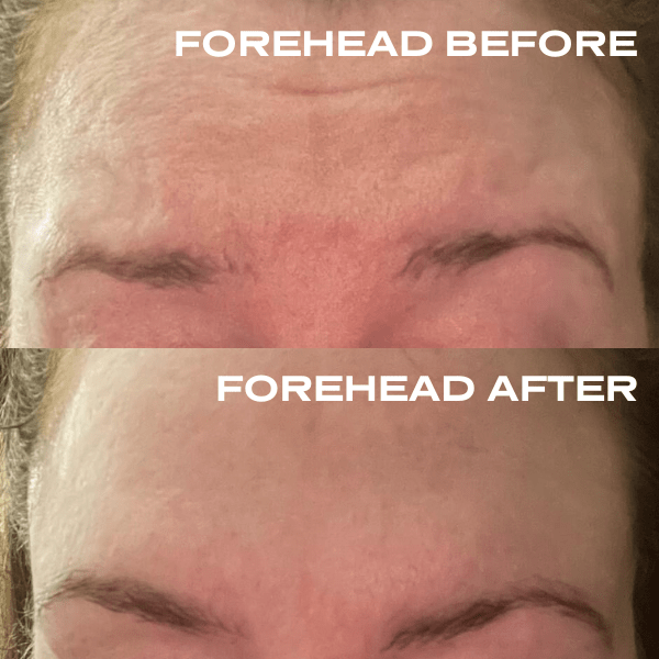 No Needles Dermal Filler - Starter Kit