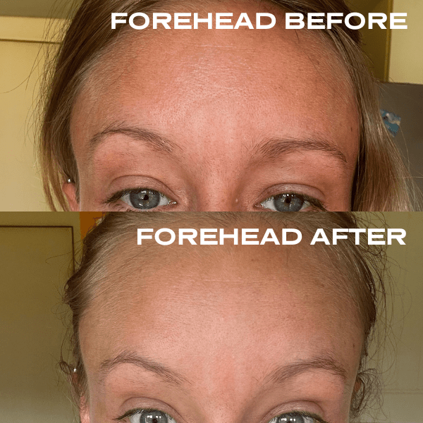 No Needles Dermal Filler - Starter Kit