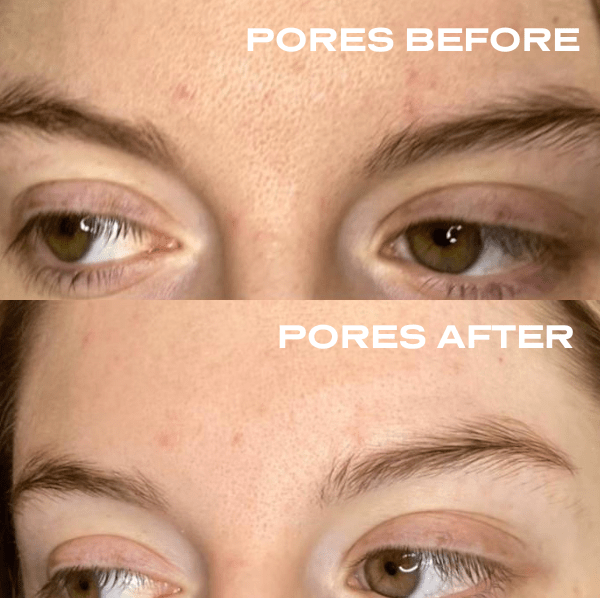No Needles Dermal Filler - Starter Kit