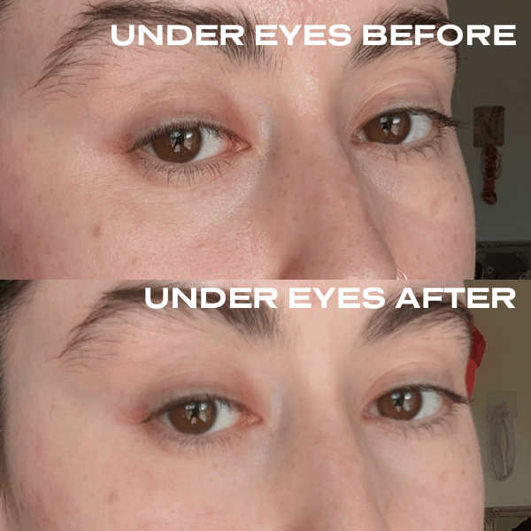 No Needles Dermal Filler - Starter Kit