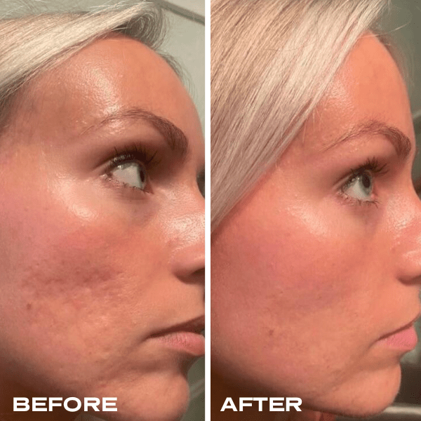 No Needles Dermal Filler - 4 Month Bundle