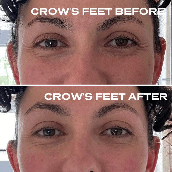 No Needles Dermal Filler - Starter Kit
