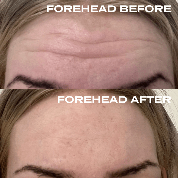 No Needles Dermal Filler - Starter Kit