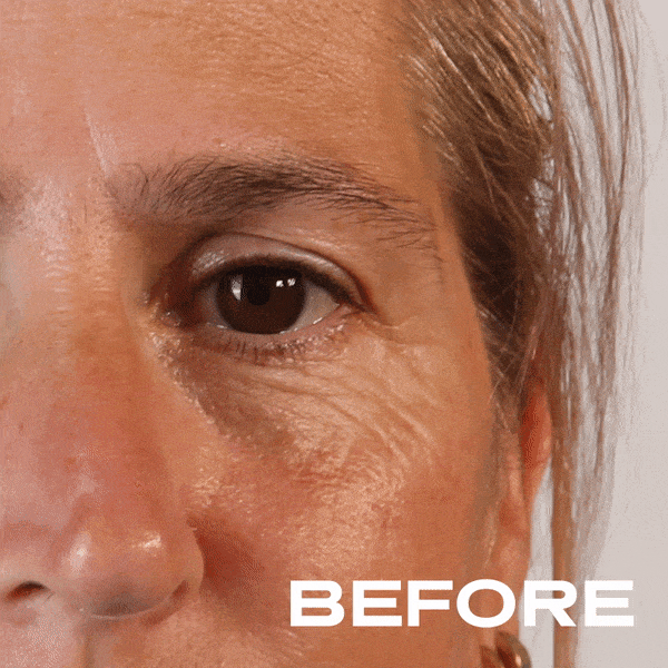No Needles Dermal Filler