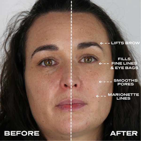 No Needles Dermal Filler