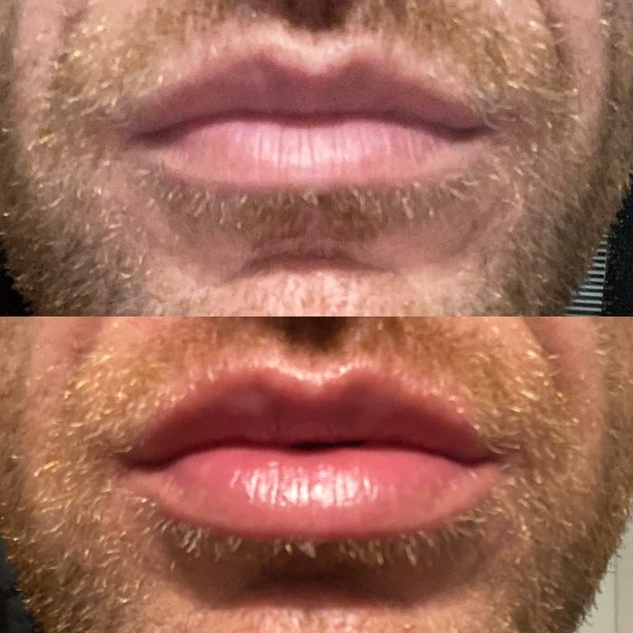 No Needles Lip Filler Kit Year Pack