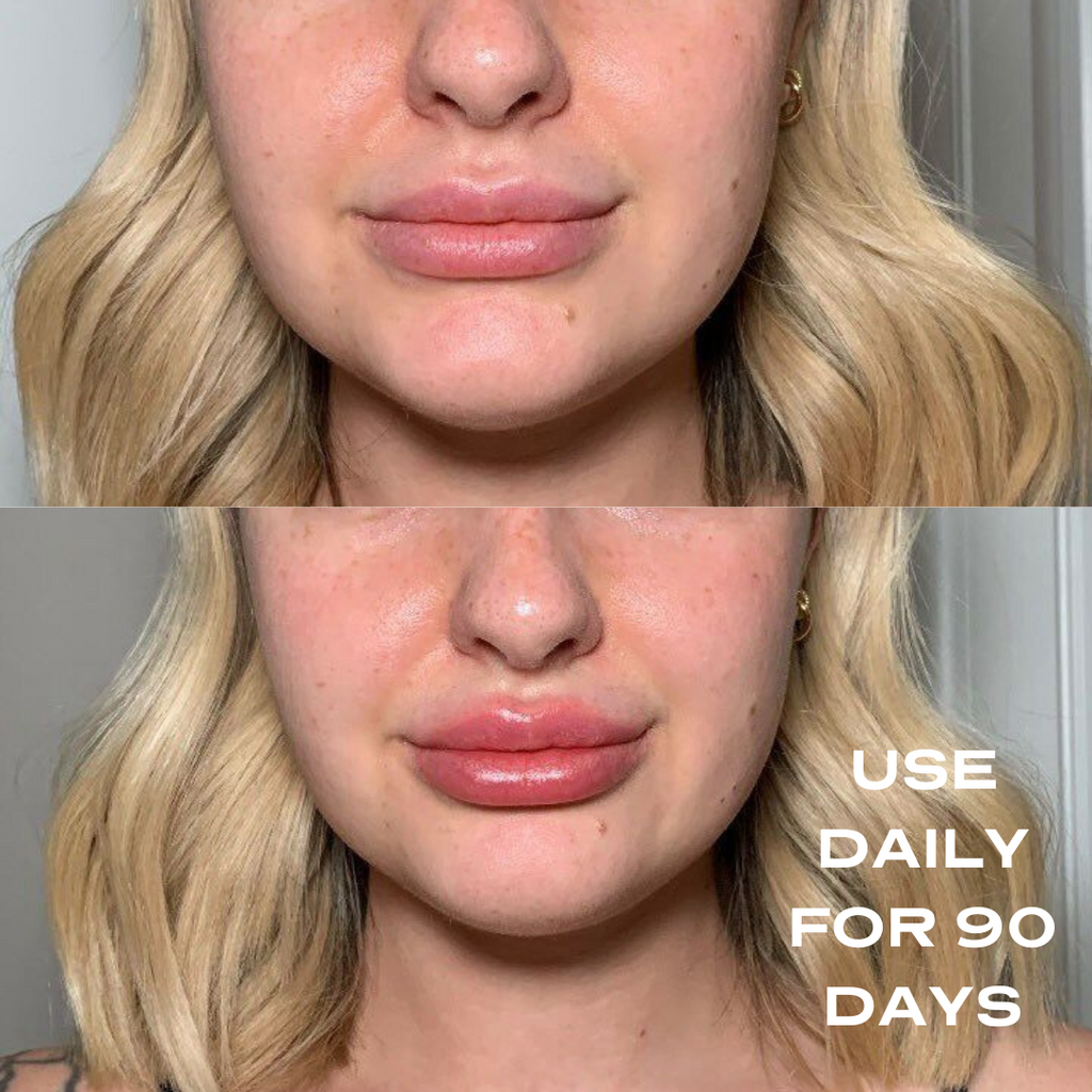 No Needles Lip Filler 1ml 90Day Package Plump it!