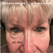 No Needles Dermal Filler