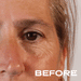 No Needles Dermal Filler