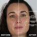 No Needles Dermal Filler