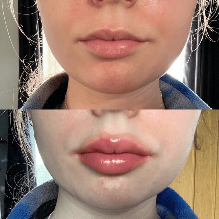 No Needles Lip Filler Kit