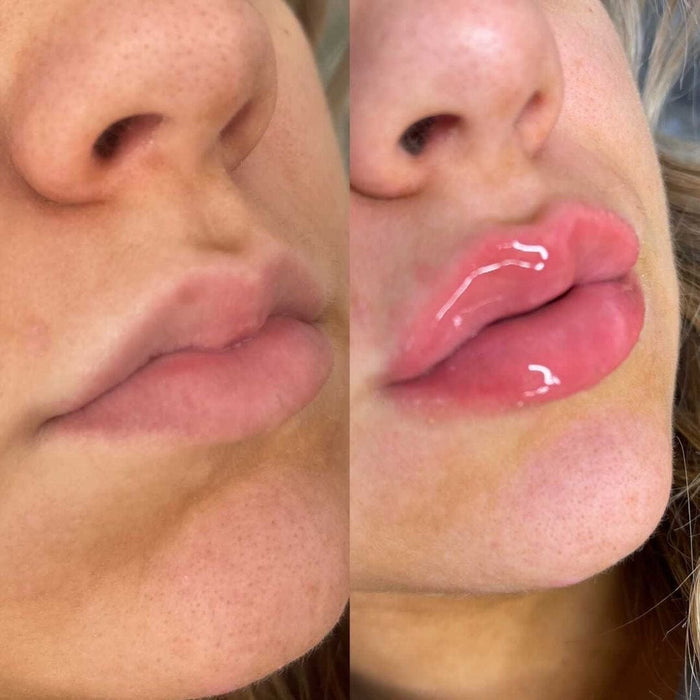 No Needles Lip Filler Kit